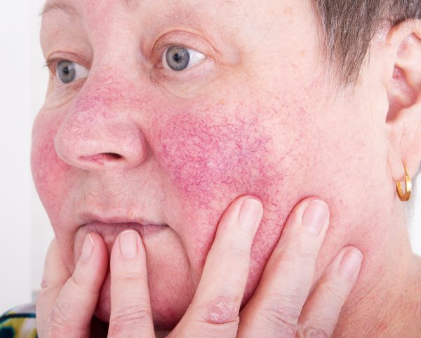 rosacea vindjehuidtherapeut.nl