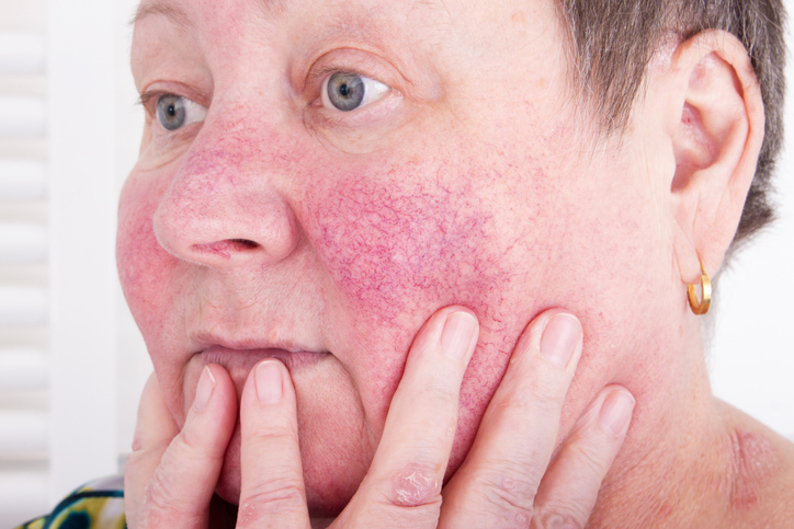 rosacea vindjehuidtherapeut.nl