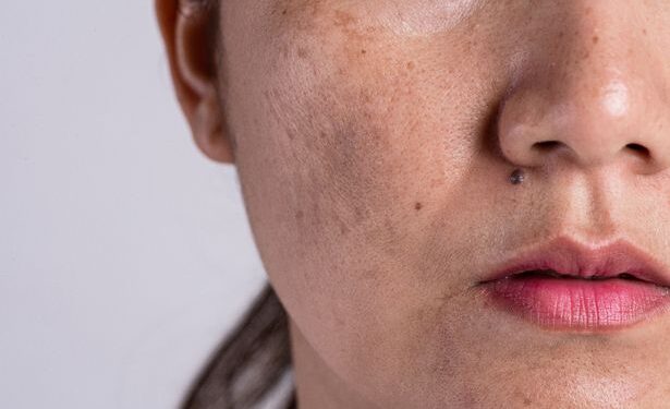 Melasma - vindjehuidtherapeut.nl