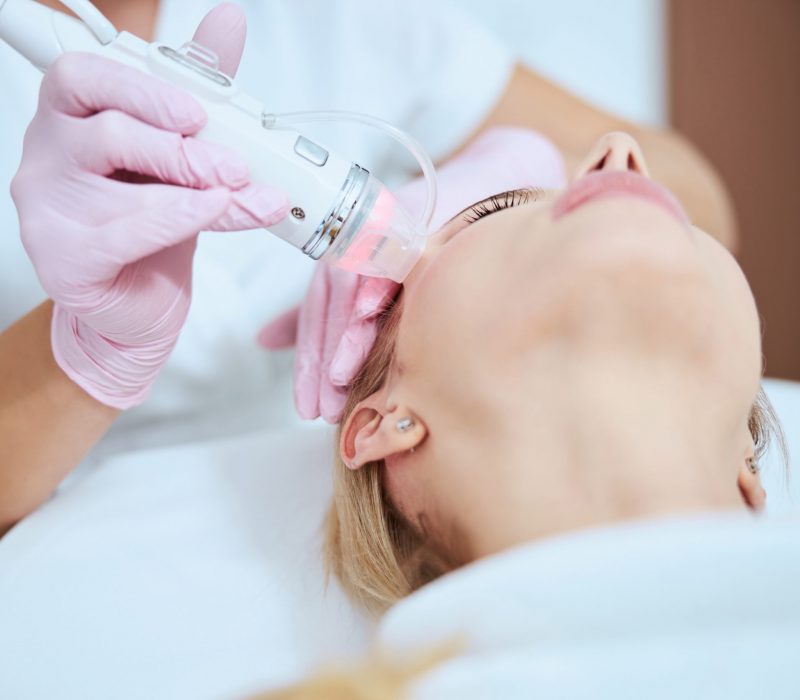 radiofrequente microneedling - vindjehuidtherapeut.nl